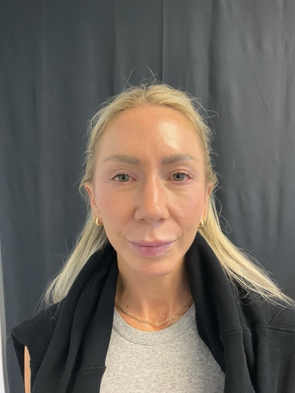 Chin Implant Before & After Image