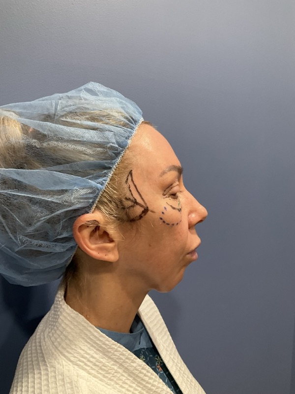 Chin Implant Before & After Image