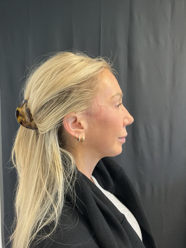 Chin Implant Before & After Image
