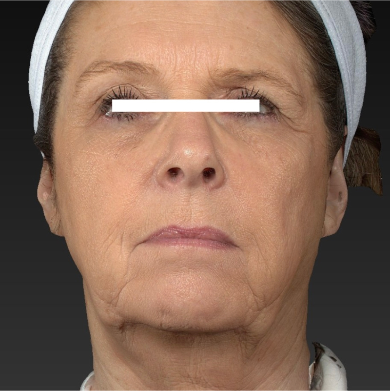 Deep Plane Facelift Before & After Image