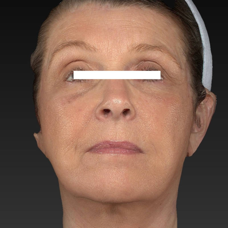 Deep Plane Facelift Before & After Image