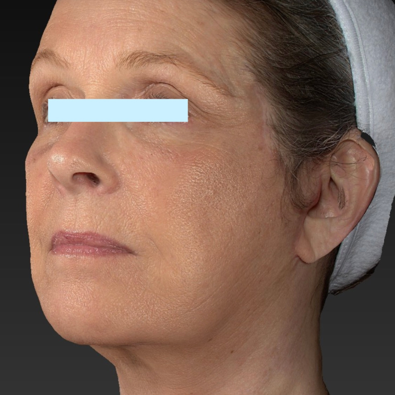 Deep Plane Facelift Before & After Image