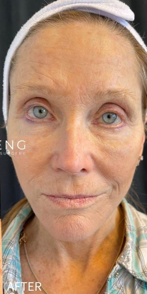 Deep Plane Facelift Before & After Image