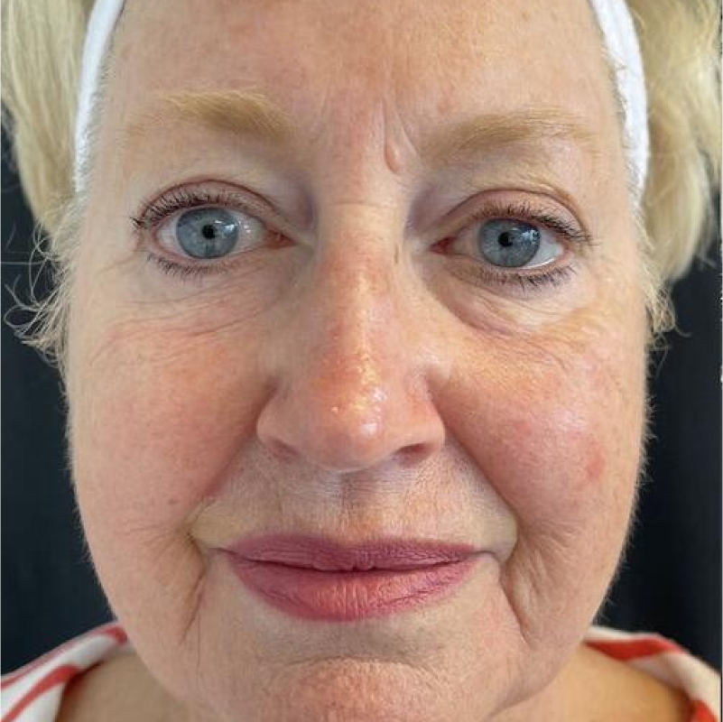 Deep Plane Facelift Before & After Image