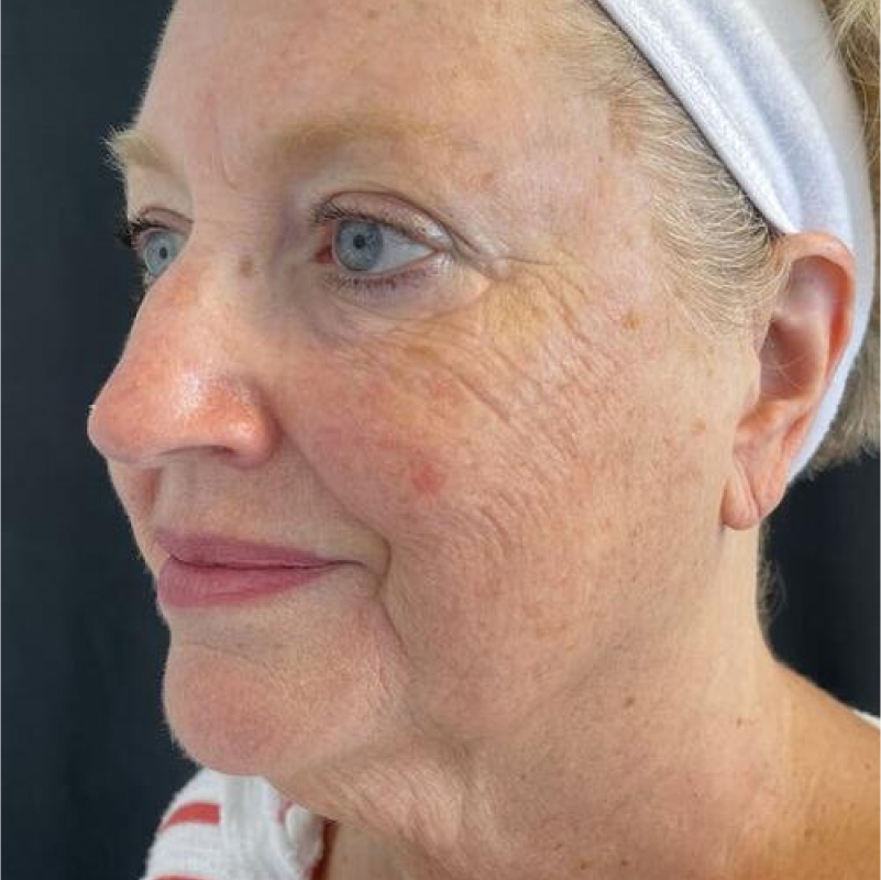 Deep Plane Facelift Before & After Image