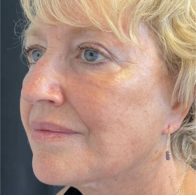 Deep Plane Facelift Before & After Image