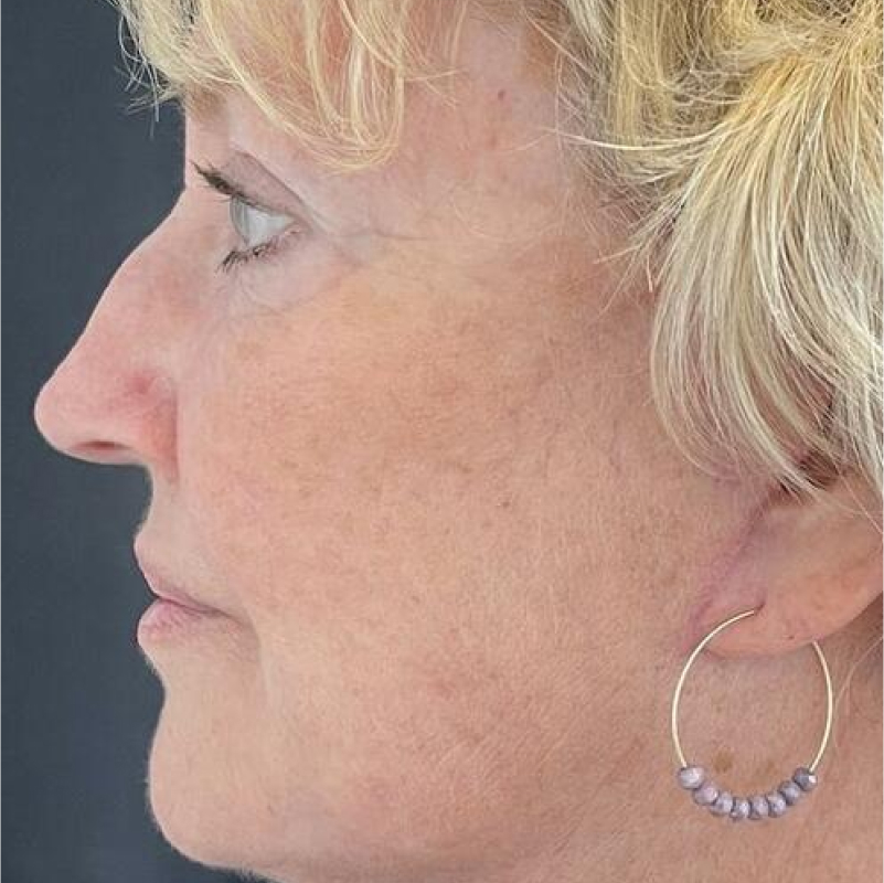 Deep Plane Facelift Before & After Image