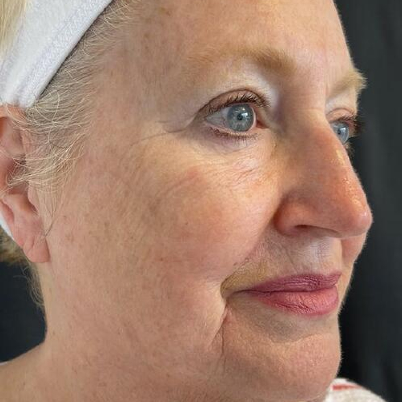 Deep Plane Facelift Before & After Image