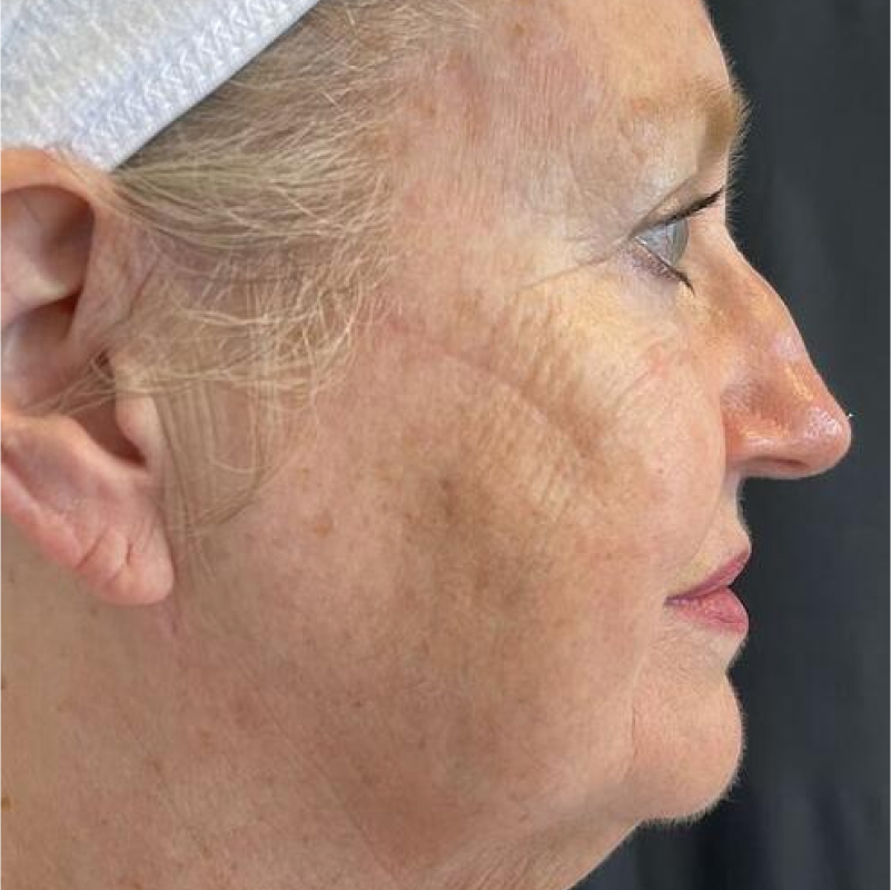 Deep Plane Facelift Before & After Image