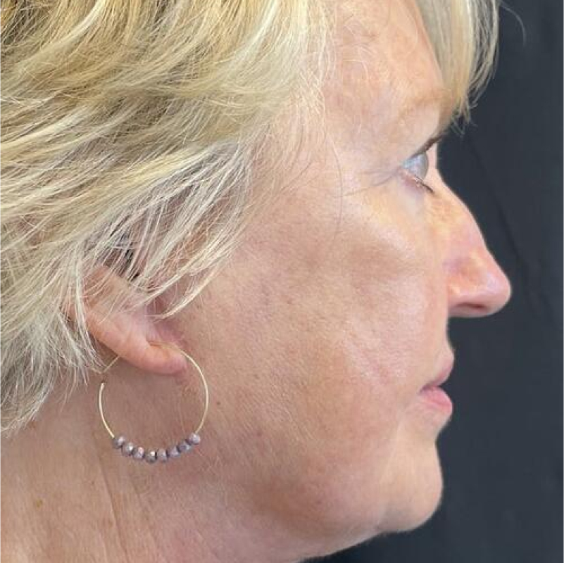 Deep Plane Facelift Before & After Image