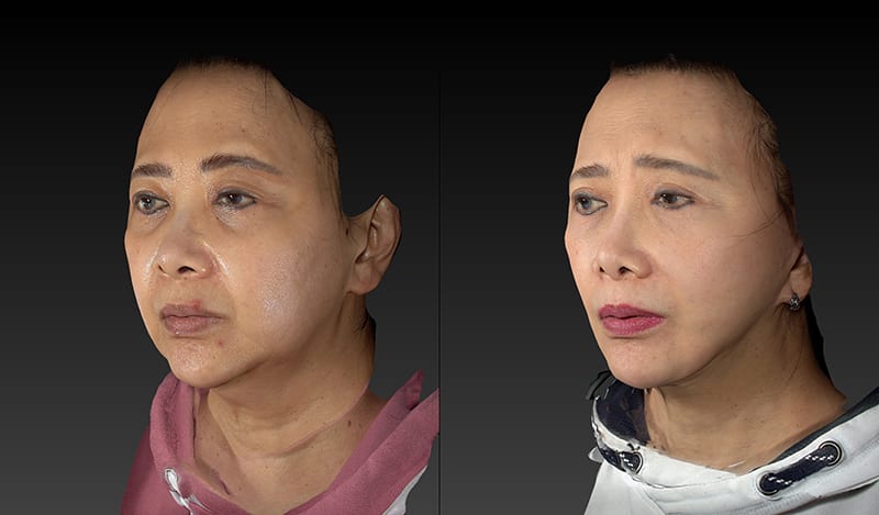 Deep Plane Facelift Before & After Image