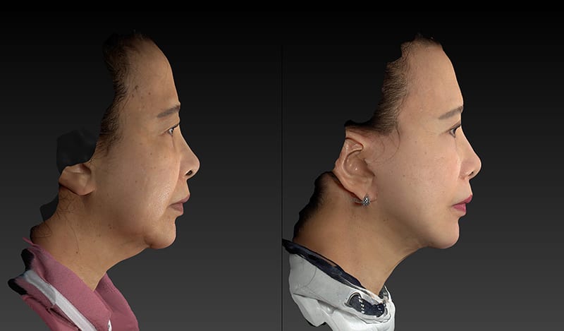 Deep Plane Facelift Before & After Image