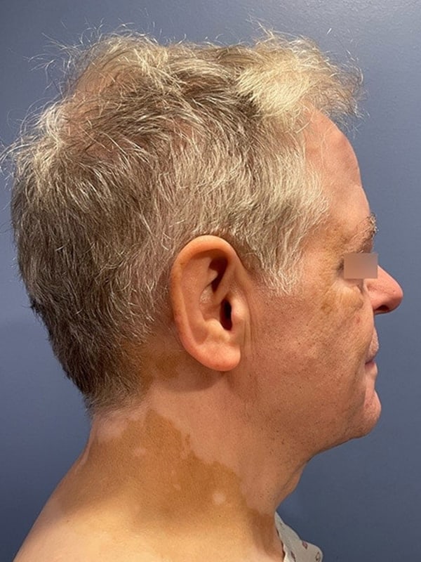 Deep Plane Facelift Before & After Image