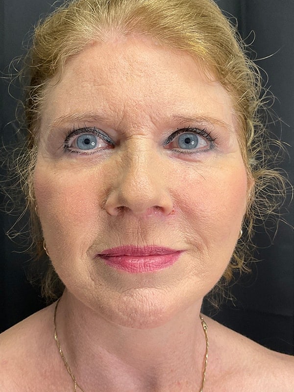 Deep Plane Facelift Before & After Image