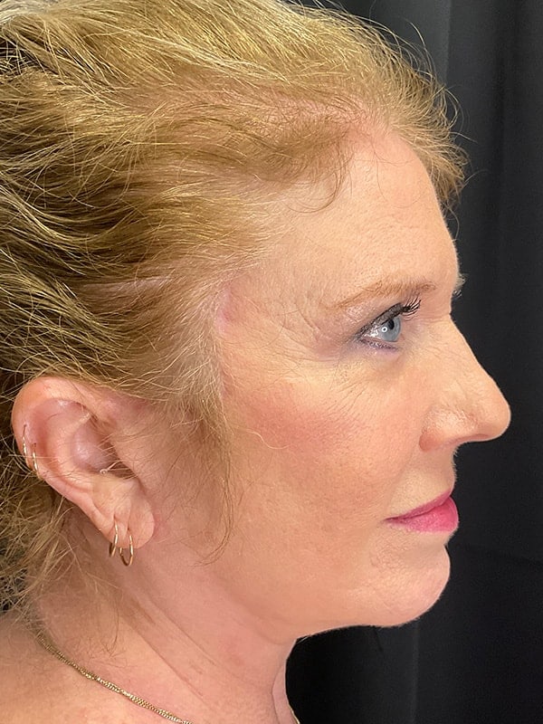 Deep Plane Facelift Before & After Image