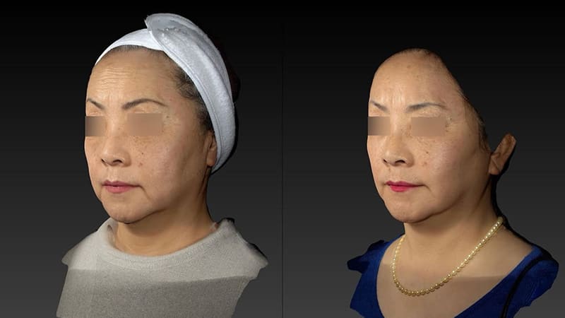 Deep Plane Facelift Before & After Image