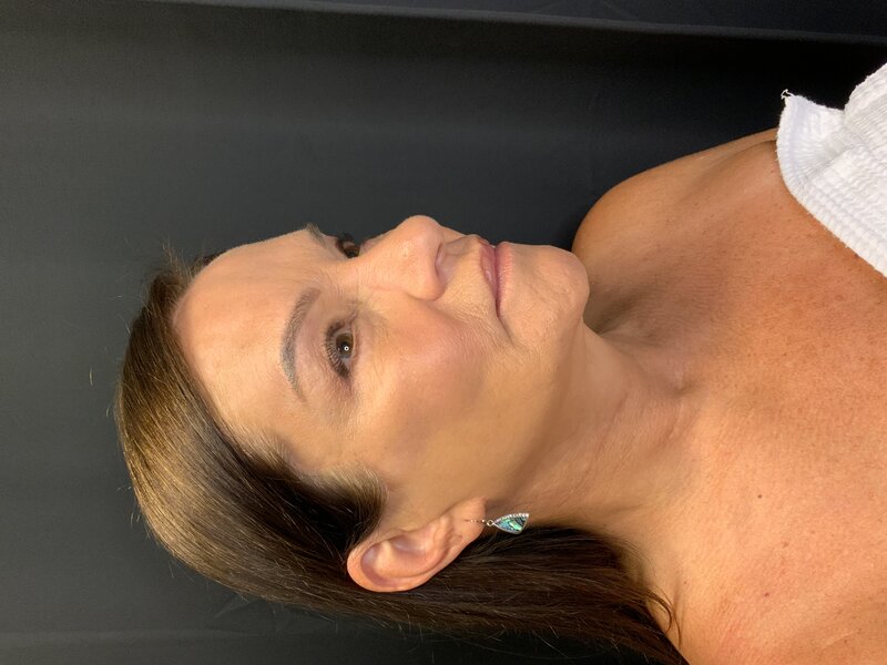 Deep Plane Facelift Before & After Image