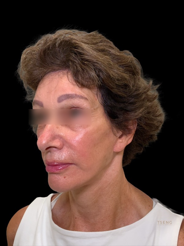 Deep Plane Facelift Before & After Image