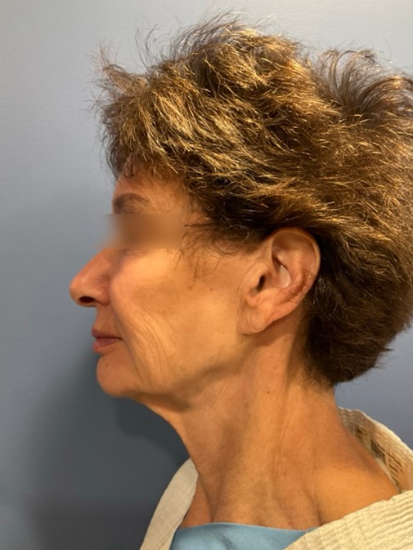 Deep Plane Facelift Before & After Image
