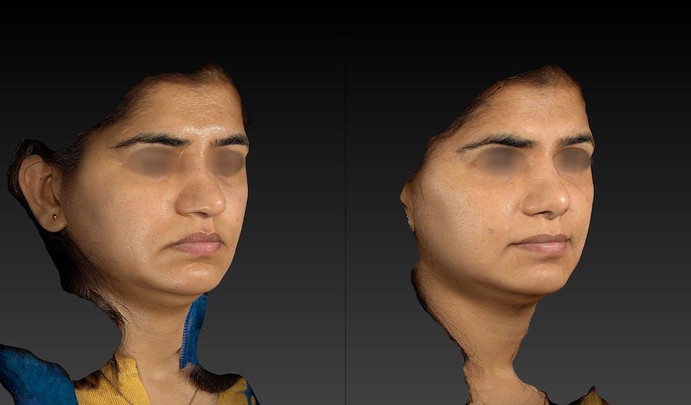 Ethnic Rhinoplasty Before & After Image