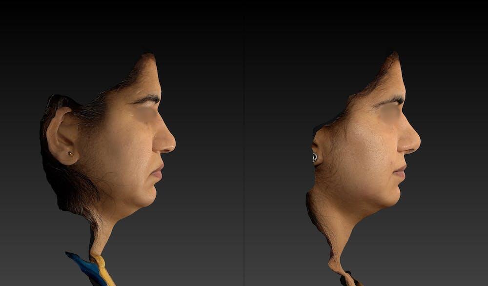 Ethnic Rhinoplasty Before & After Image