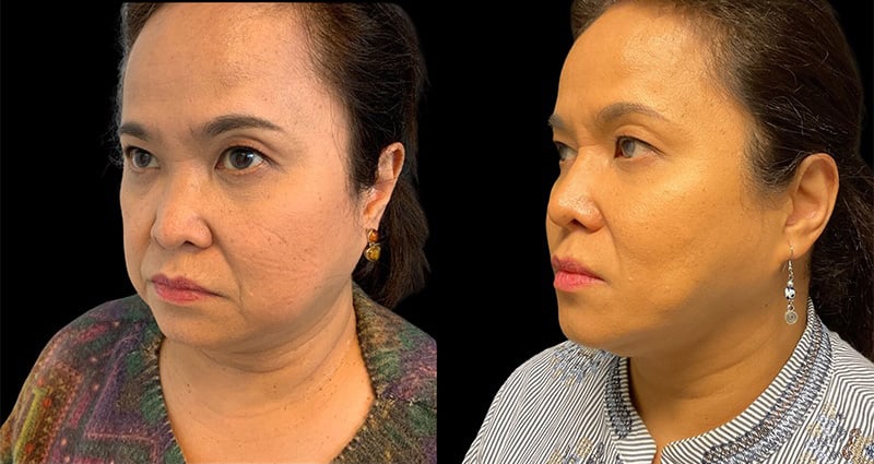 Ethnic Rhinoplasty Before & After Image