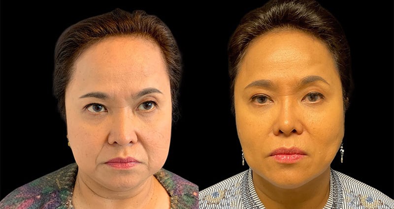 Ethnic Rhinoplasty Before & After Image