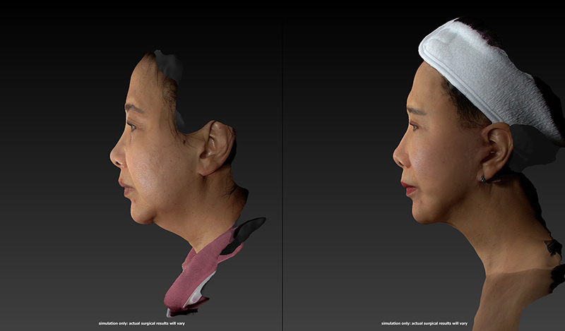 Ethnic Rhinoplasty Before & After Image