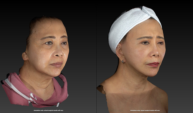 Ethnic Rhinoplasty Before & After Image