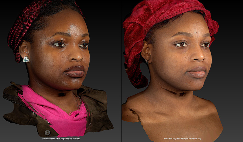 Ethnic Rhinoplasty Before & After Image