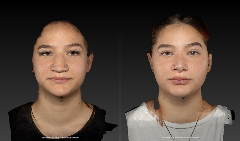 Ethnic Rhinoplasty Before & After Image