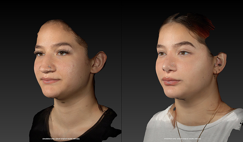 Ethnic Rhinoplasty Before & After Image