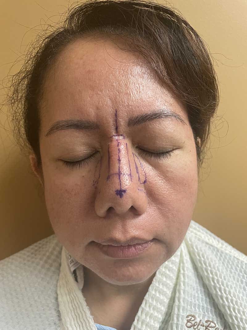 Ethnic Rhinoplasty Before & After Image