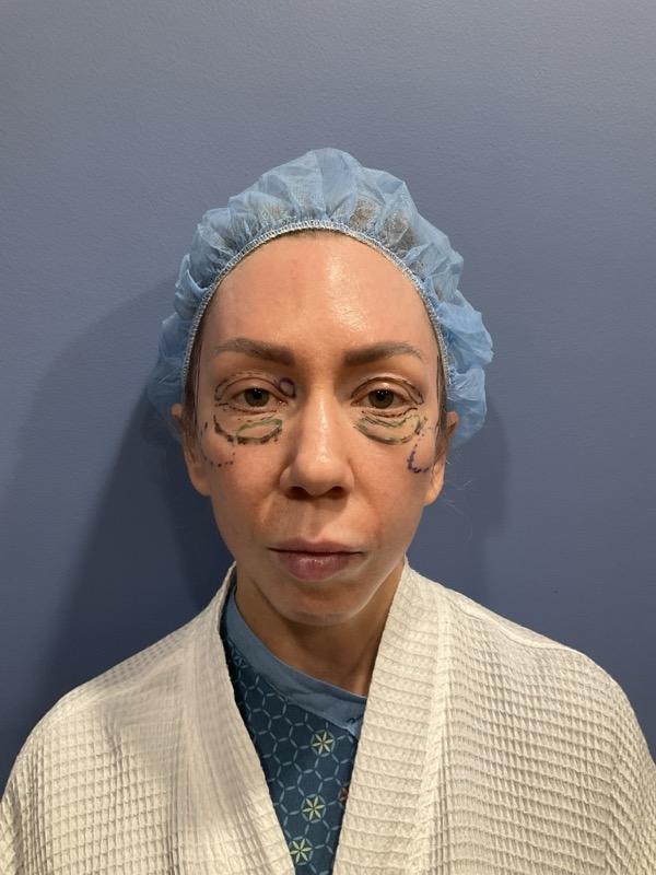 eyelid surgery Before & After Image