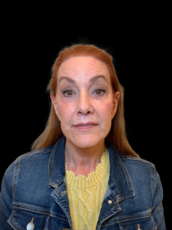 eyelid surgery Before & After Image