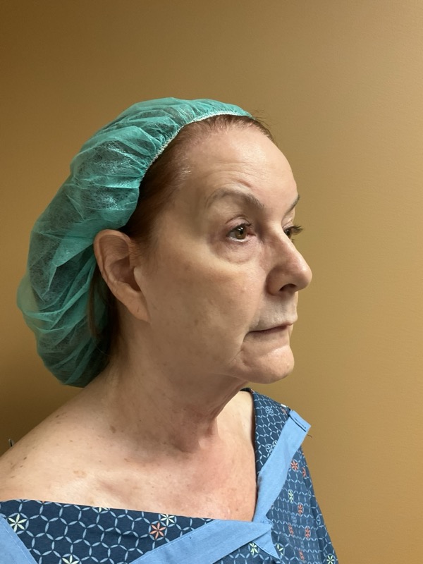 eyelid surgery Before & After Image