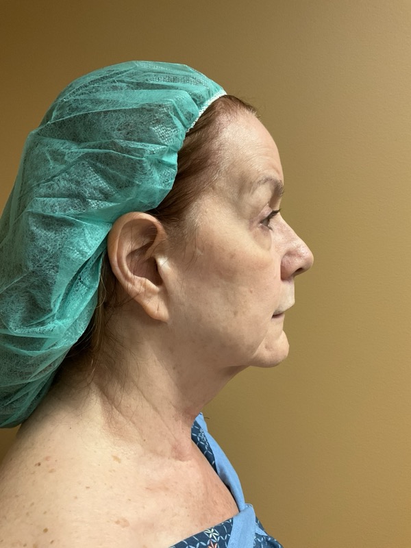 Eyelid Surgery Before & After Image