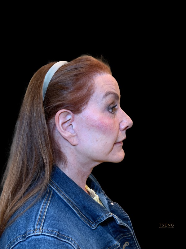 Eyelid Surgery Before & After Image