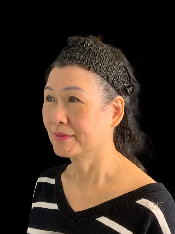 eyelid surgery Before & After Image