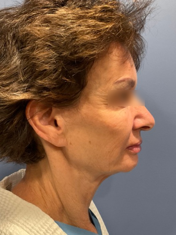 Eyelid Surgery Before & After Image