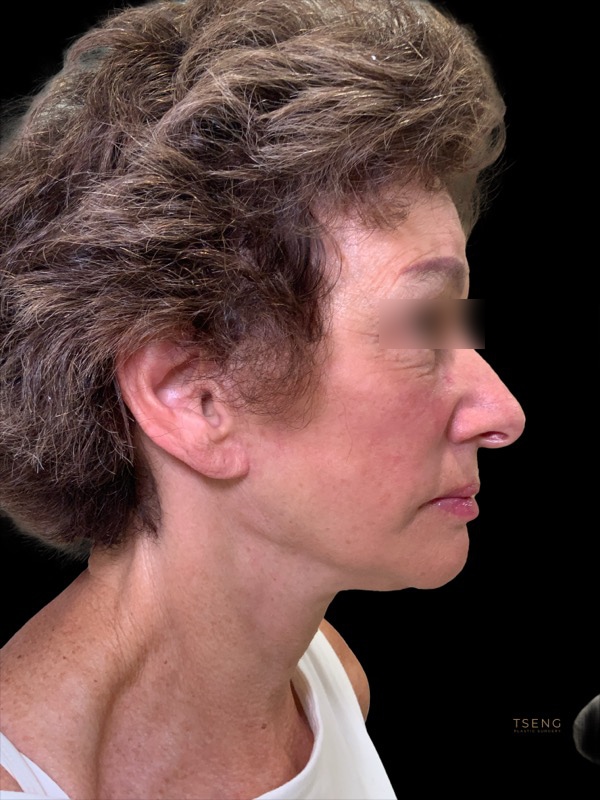 Eyelid Surgery Before & After Image
