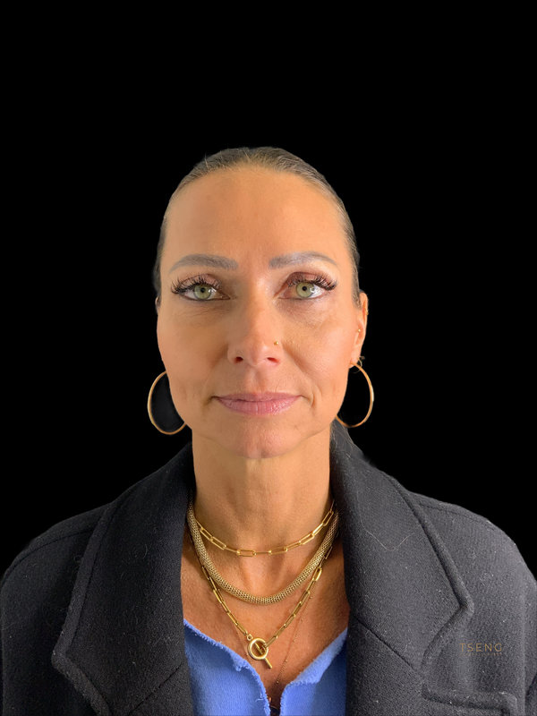 Eyelid Surgery Before & After Image