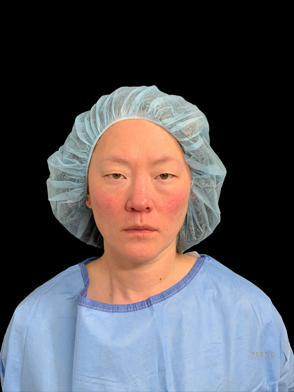 Eyelid Surgery Before & After Image