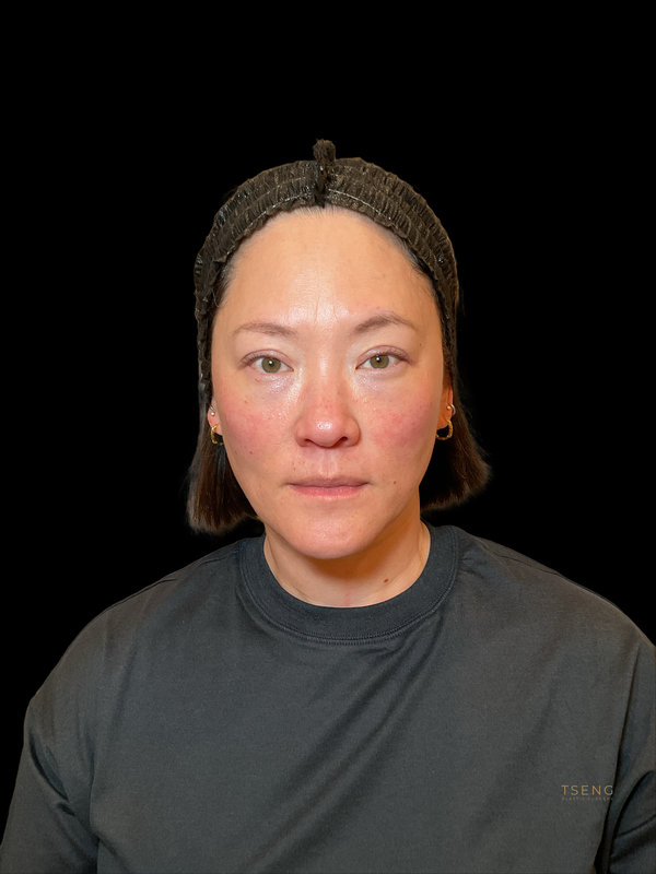 Eyelid Surgery Before & After Image