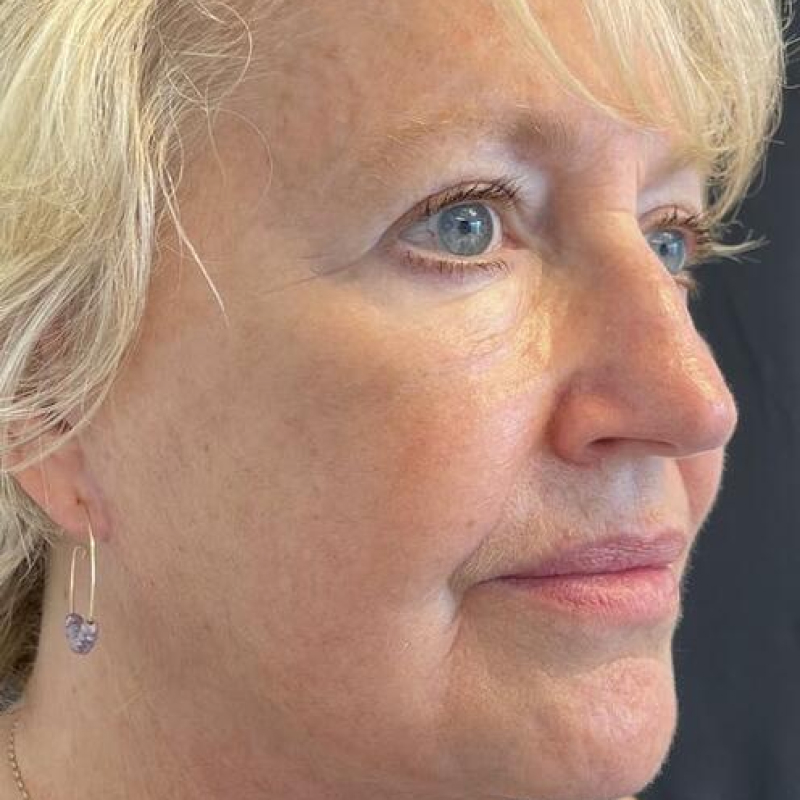 Facelift Before & After Image