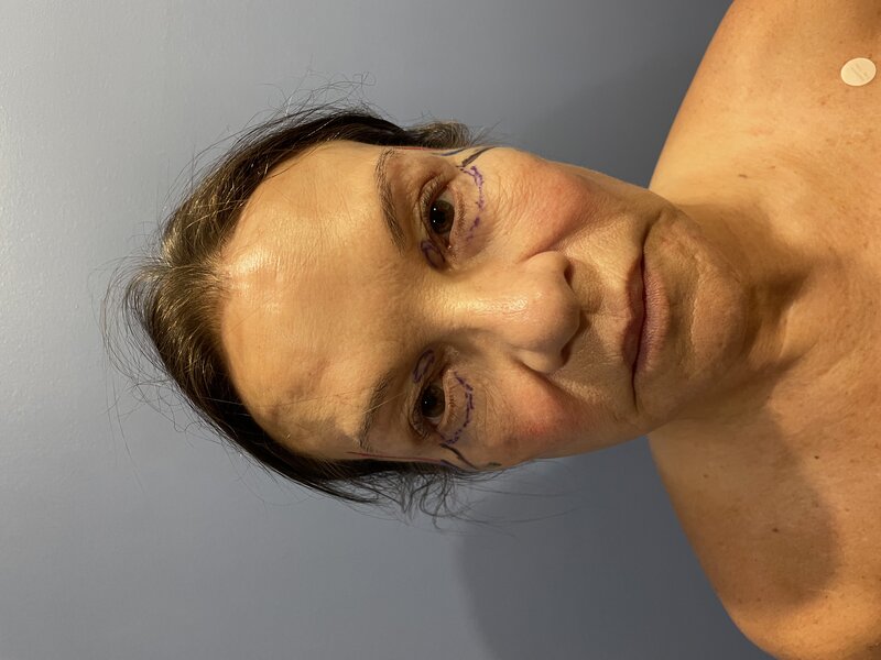 Facelift Before & After Image