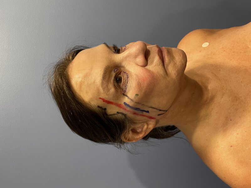 Facelift Before & After Image