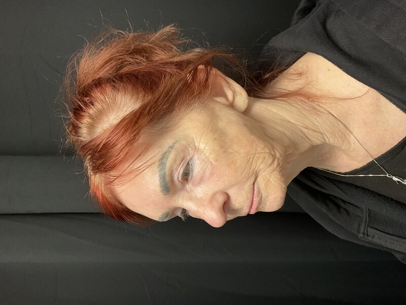 Facelift Before & After Image