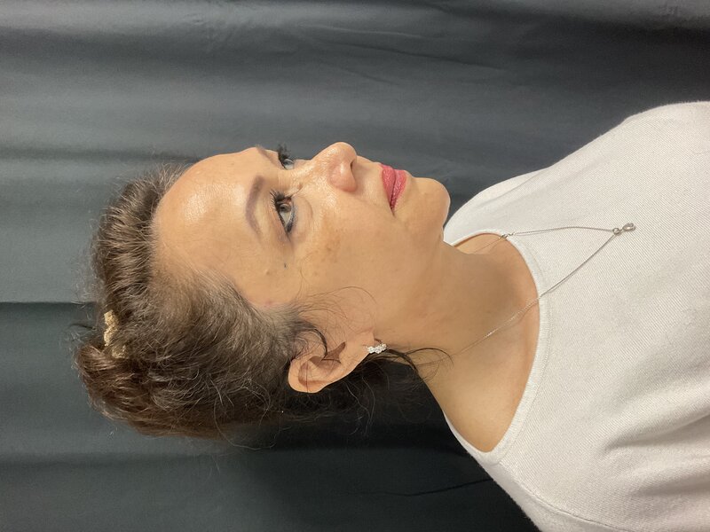 Facelift Before & After Image