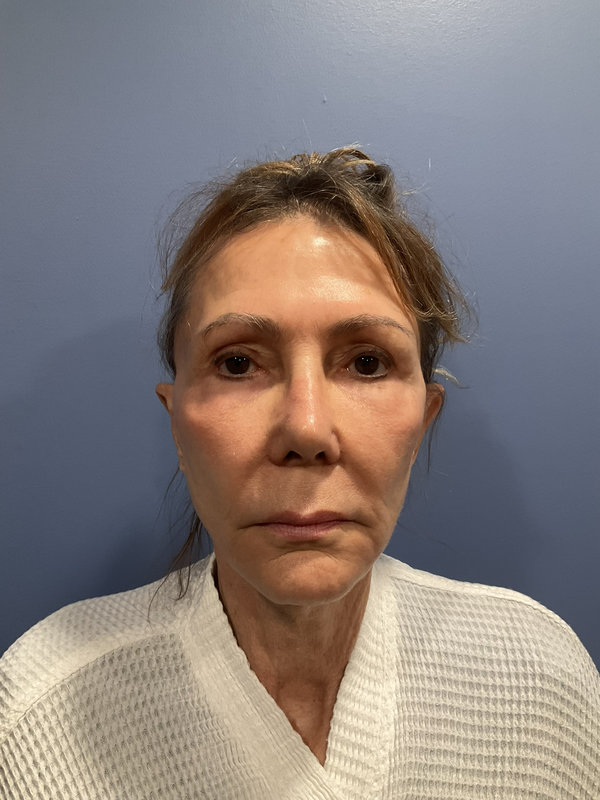 Facelift Before & After Image
